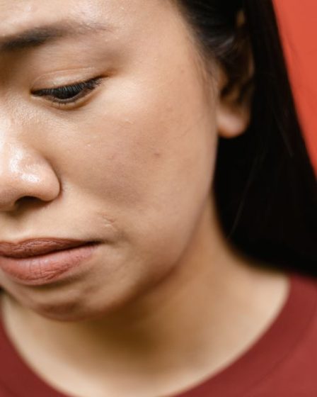 Fungal Acne Treatment: Symptoms, Causes, and Best Products Fungal Acne Treatment: Symptoms, Causes, and Best Products